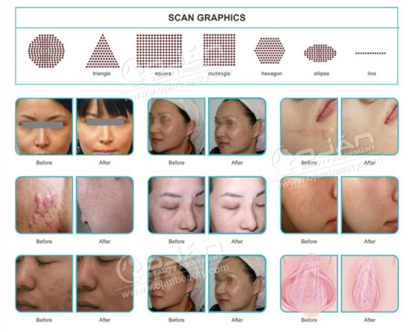 laser hair removal co2 laser dermatologiy