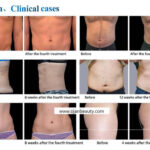 Electro Magnetic Fat Removal Shape HIEMT EMS Sculpting Machine | Body Sculpting Machine - Image 5