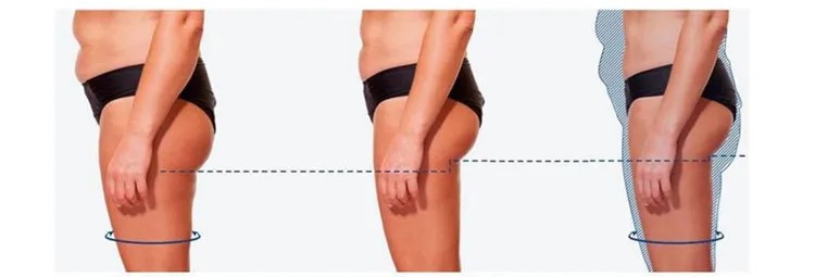 Results Of Portable Fat Reduction And Body Contouring Equipment