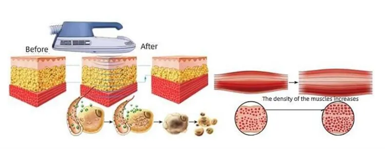 Working Theory Of Portable 4-Handle EMS & RF Body Sculpting Machine
