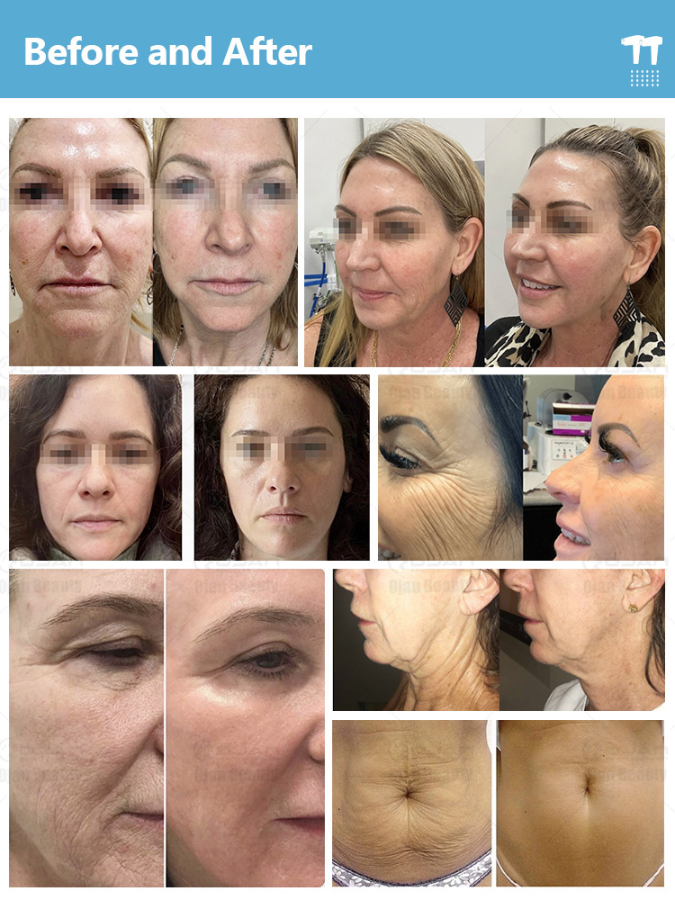 Anti Aging Device | Skin Rejuvenation Machine