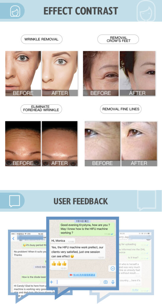 HIFU Facial Before And After Long-Term Results