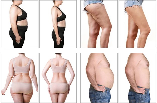Benefits of 5D MaxLipo Laser
