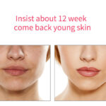 ems v shape face chin lift messager