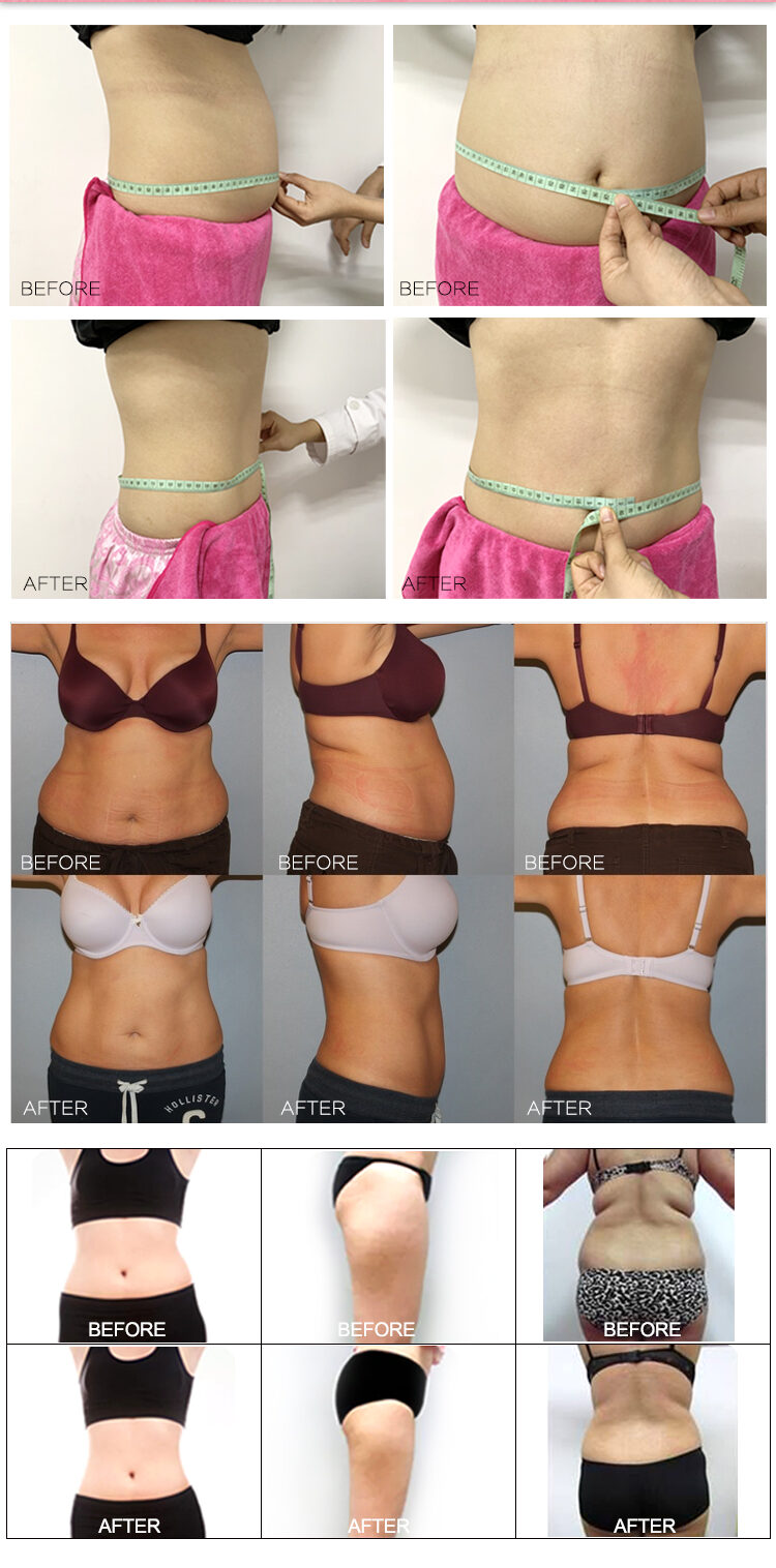 Japanese Mitsubishi 650 nm & 980 nm Dual Wavelength Lipo Laser Machine Before & After Result