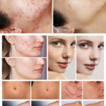 Before & After result Of CO2 Fractional Laser & Q Switch Laser Beauty Machine