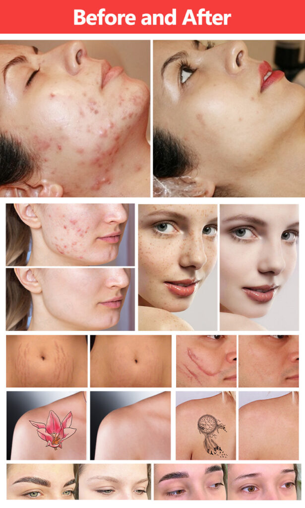 Before & After result Of CO2 Fractional Laser & Q Switch Laser Beauty Machine