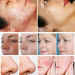 Thulium Laser Beauty Machine Advanced Fractional CO2 Skin Rejuvenation Equipment