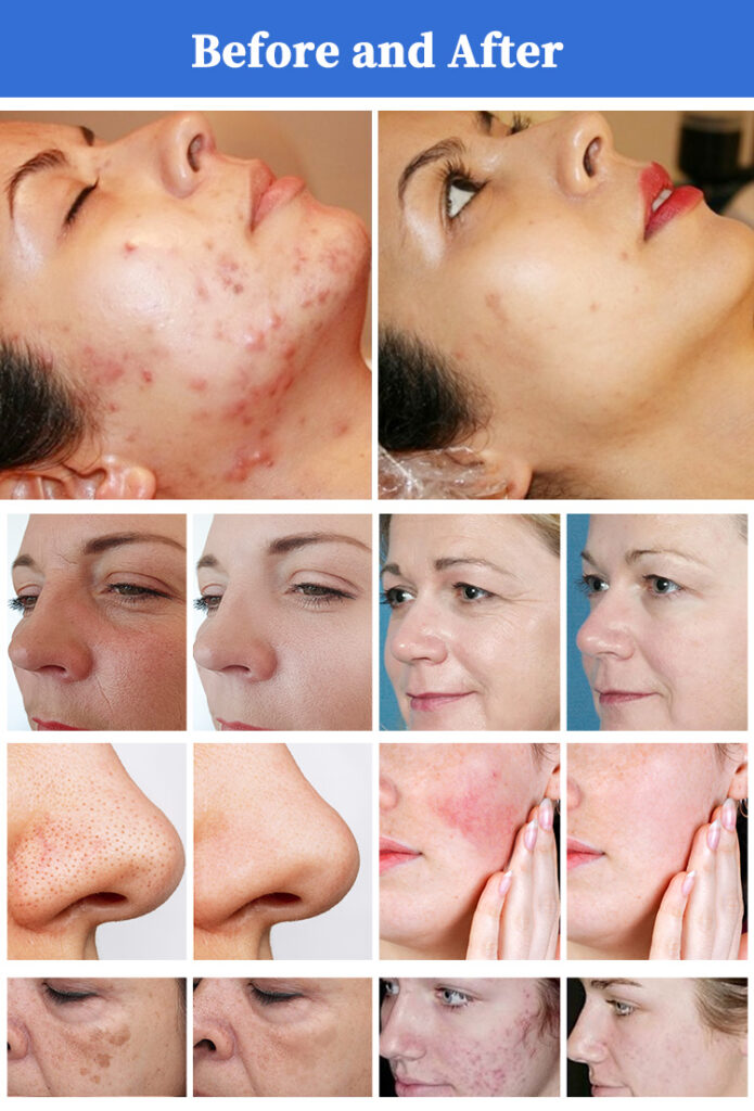 Before And After Result Of Thulium Laser Beauty Machine Advanced Fractional CO2 Skin Rejuvenation Equipment