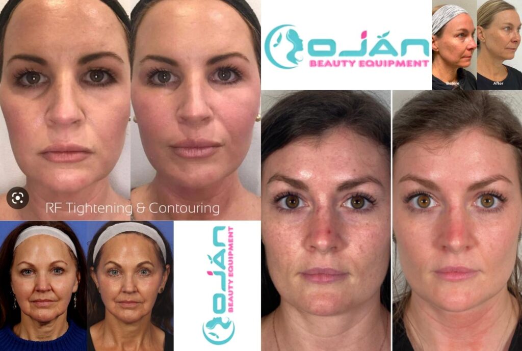 Comparing RF Microneedling Before and After – Real Results You Can See