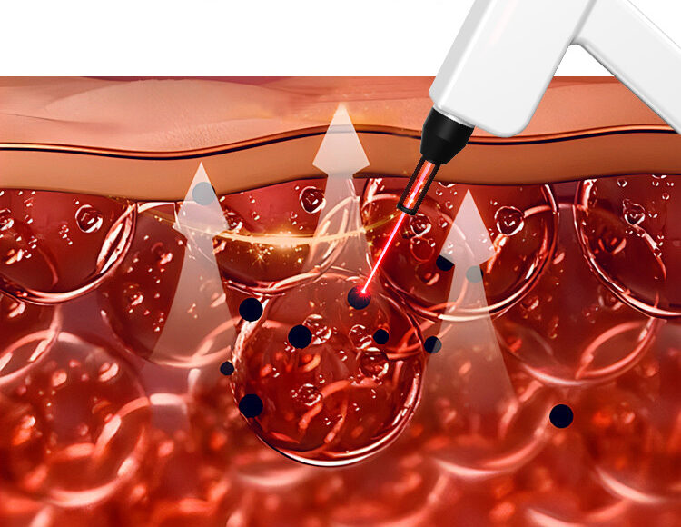 How It Works Q-Switch Laser