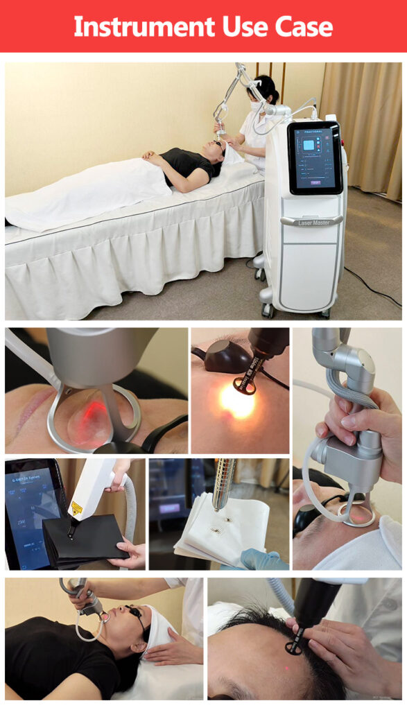 Instrument Use Case Of 2 In 1 CO2 Fractional Laser & Q Switch Laser Skin Care Beauty Machine