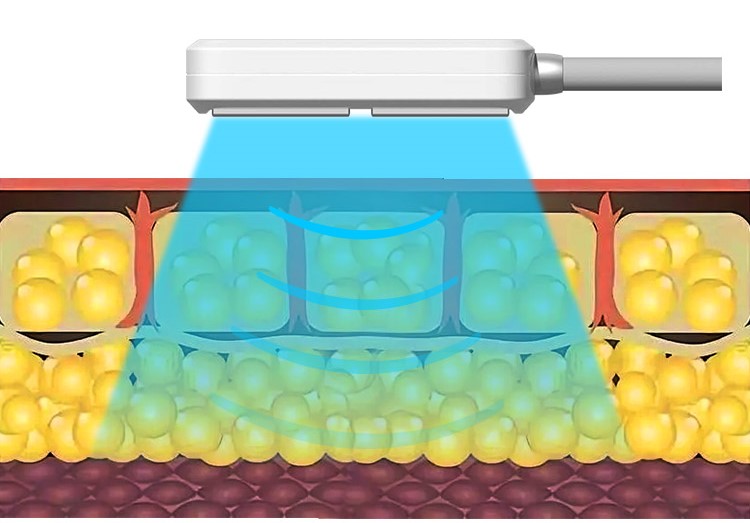 Working Theory Of 10D Maxlipo Master Cryo Plate (Cryolipolysis)