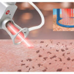 Working Theory Of CO2 Fractional Laser