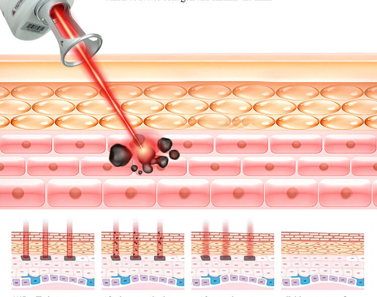 Working Theory - Thulium Laser Beauty Machine How It Works
