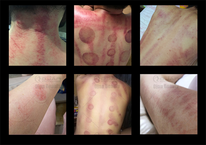 After Treatment Of EMS Body Sculpting