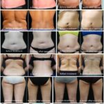 Before And After Result Of Ice Sculpture Board Cryolipolysis Machine