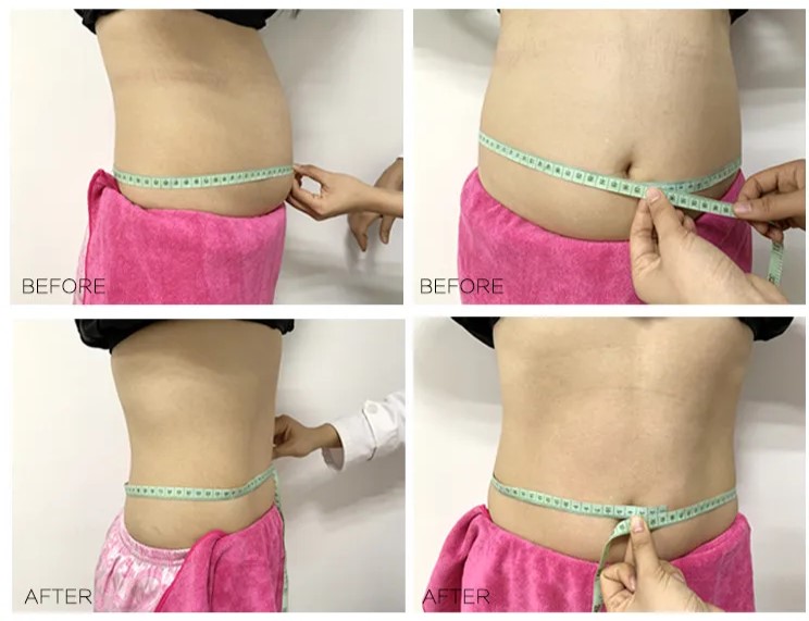Benefits of Laser Lipo for Fat Reduction & Body Sculpting