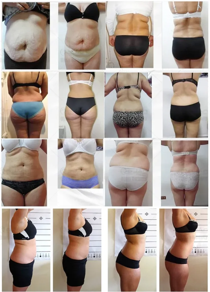 Lipo Laser Machine Weight Loss Before & After Result