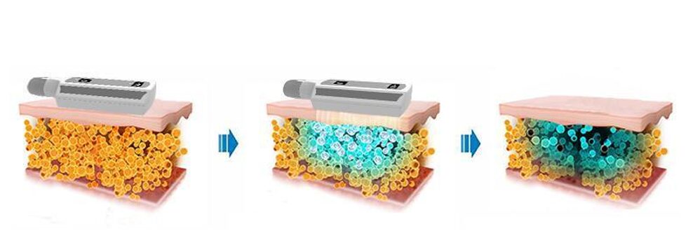 Working Theory Of 8 Handle Ice Sculpture Board Cryolipolysis Machine