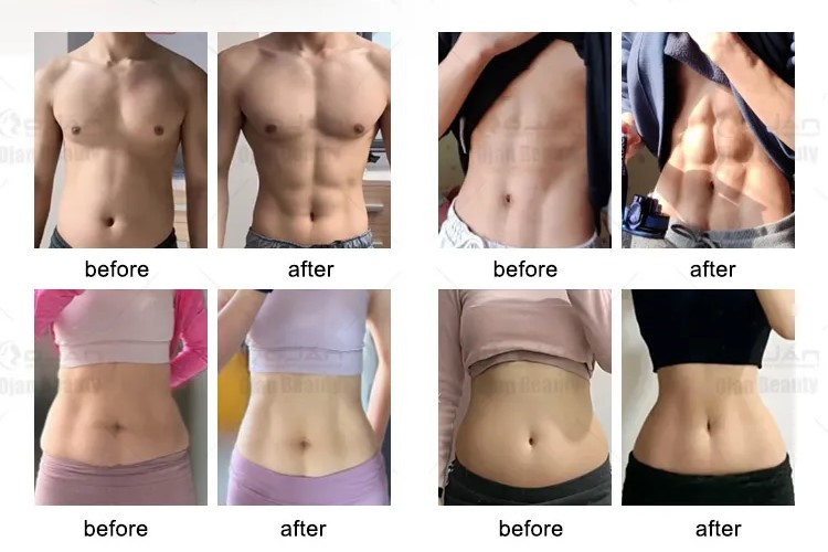 Body Sculpting Machine Results